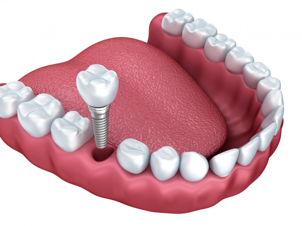 Les avantages des implants dentaires